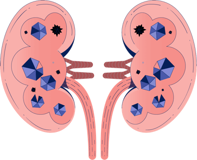 Oxalate in Kidneys Illustration