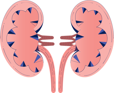 Progressive Kidney Damage Illustration