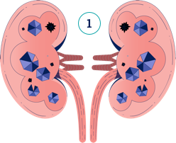 Ilustración de piedras en el riñón