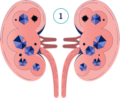 Illustrazione calcoli renali