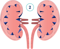 Ilustración de nefrocalcinosis