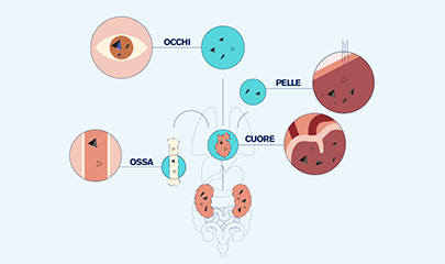 Illustrazione ossalosi sistemica