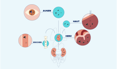 Illustration systemische Oxalose