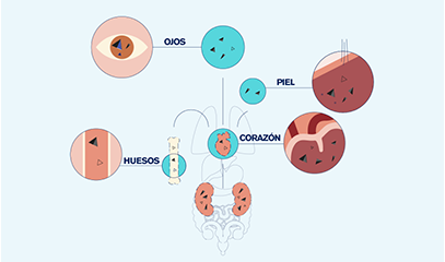 Ilustración de oxalosis sistémica